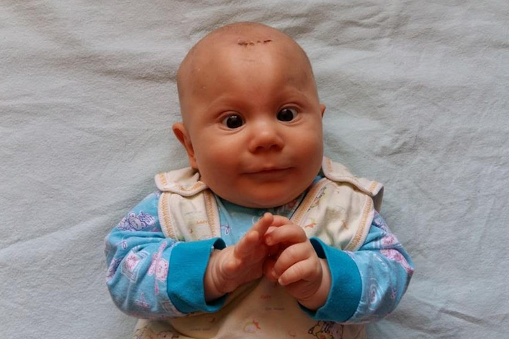Специальные протезы для головы спасут младенца из Новосибирска