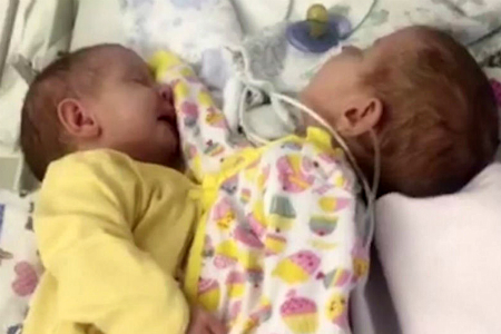 Московские врачи разделили сиамских близнецов из Новосибирска