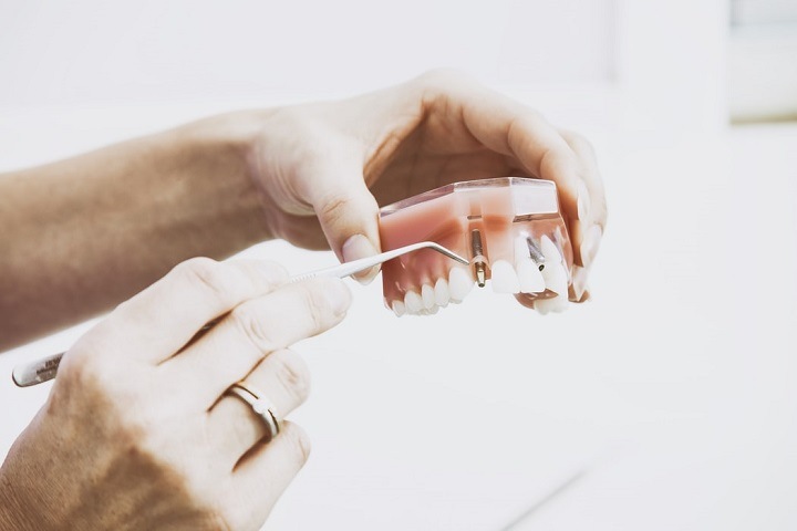 Зубные импланты и их особенности