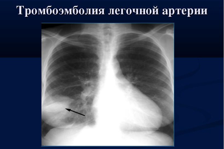 Красноярские хирурги впервые извлекли тромб из легких пациента