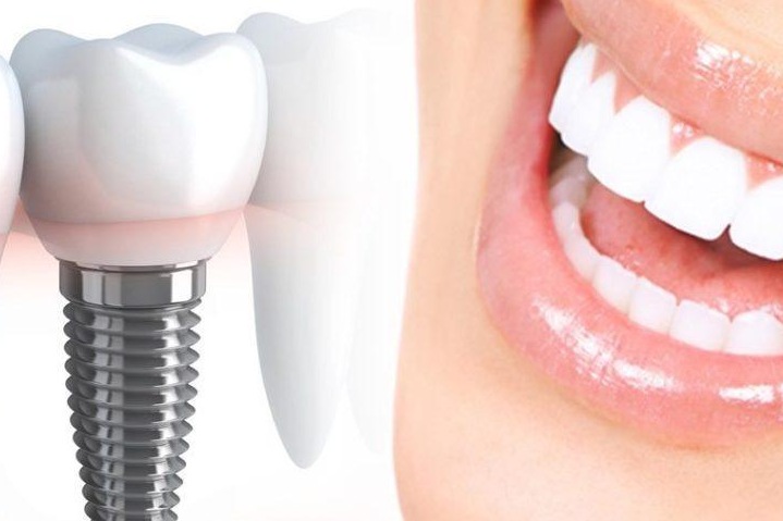 Имплантация и протезирование зубов. Особенности