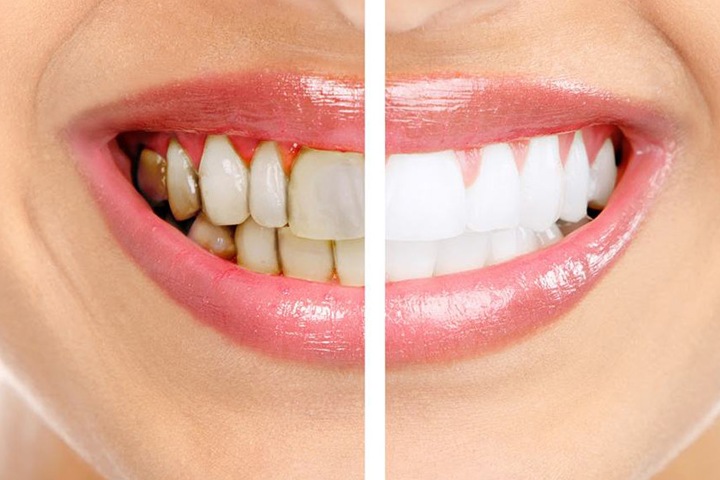 Зубной камень и другие услуги стоматолога