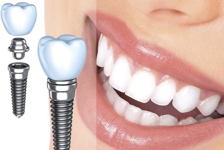 Имплантация зубов – особенности