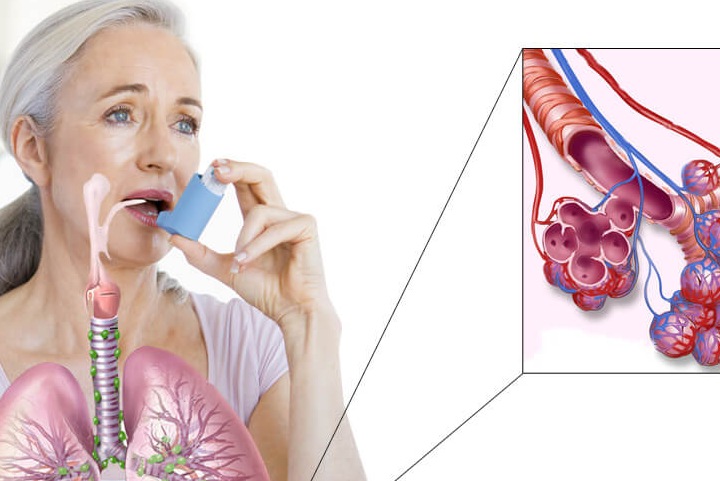 Заболевания органов дыхания. Лечение астмы