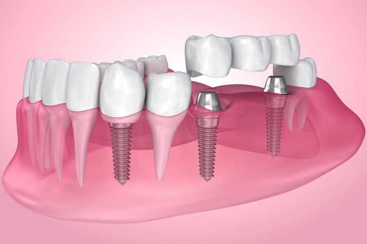 6 фактов. Что нужно знать об имплантах зубов?