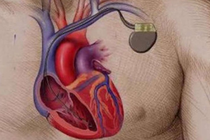 Как изменится жизнь после установки кардиостимулятора?