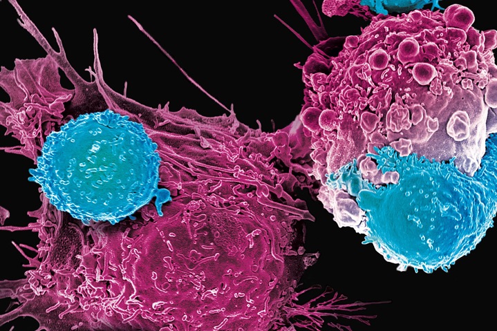 CAR T Cell Therapy: новый метод лечения онкологии с уникальной перспективой