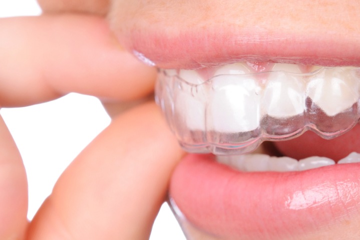 Можно ли выровнять зубы в 30 лет: что говорят ортодонты