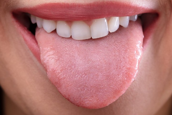 Как убрать налет на языке: лучшие способы лечения