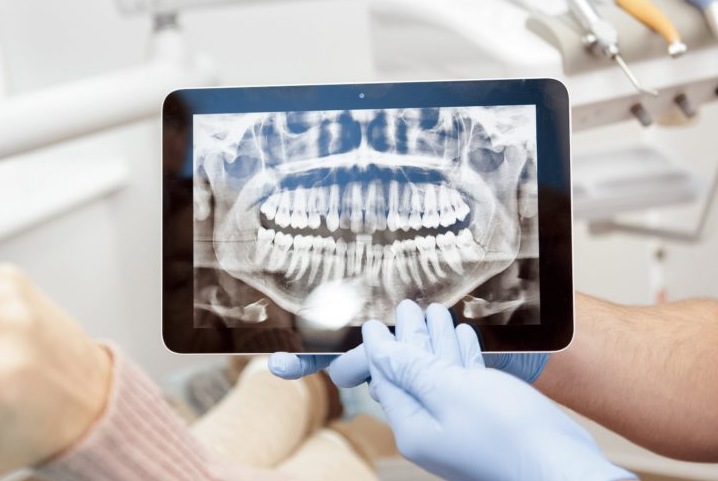Компьютерная томография зубов, особенности процедуры