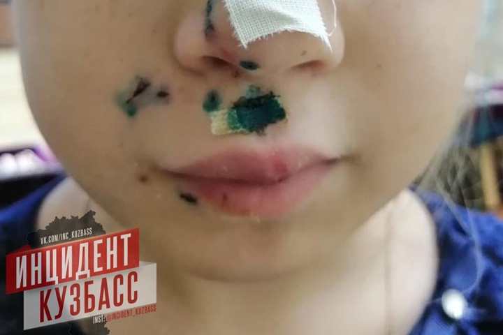 Бродячая собака разорвала лицо маленькой девочке в Кузбассе