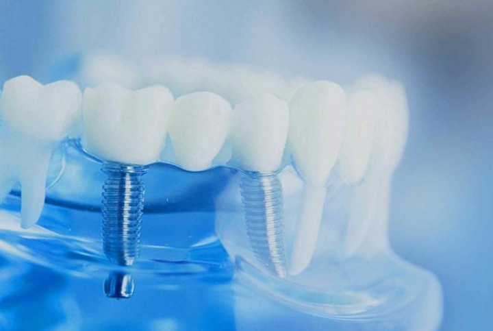 Особенности имплантации зубов в современной стоматологии