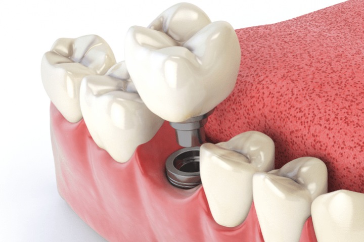 Протезирование зубов – клиника ДИНАСТИЯ