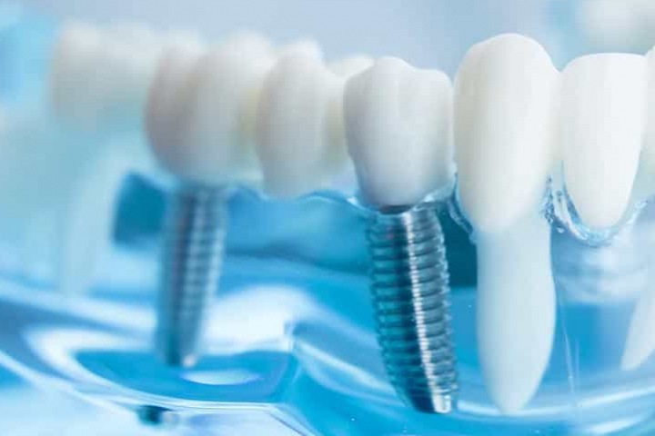 Имплантация зубов в стоматологической клинике “Сахар”