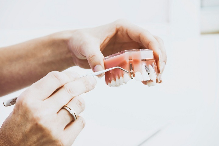 Томские ученые создали технологию производства керамических зубных имплантов